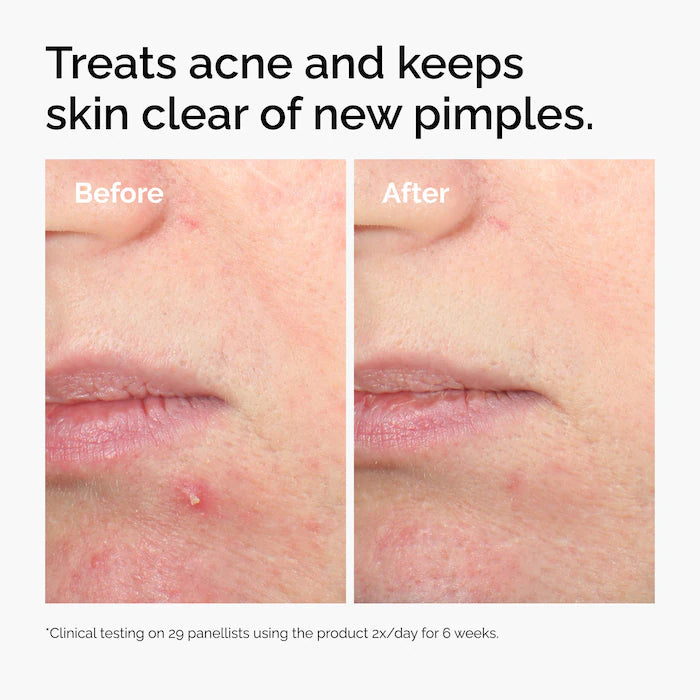 Salicylic Acid 2% Solution, Exfoliating Serum for Acne - The Ordinary